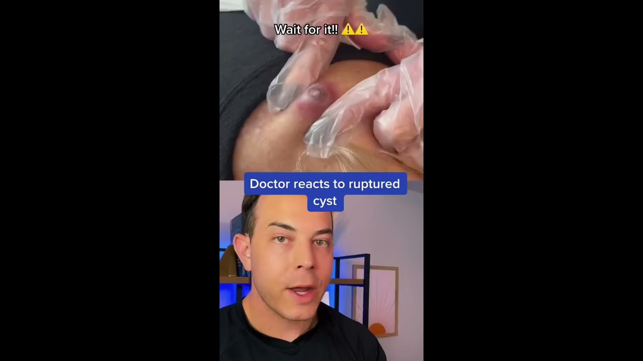 HUGE Painful Cyst Needs To Pop 208SkinDoc