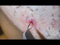Plucking facial hair & ingrown hair 1445 頬髭抜き(埋没毛あり)