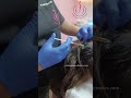 PRP/GFC for hair loss treatment by Dr. P at AWISH clinic