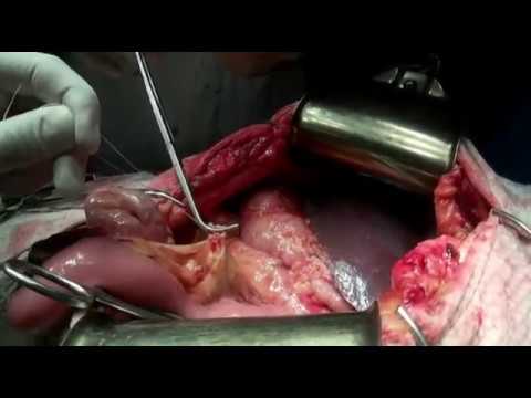Open totall gastrectomy, D2
