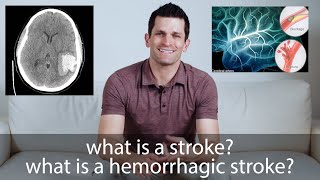 Hemorrhagic Stroke // everything you need to know
