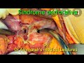 Sindrome perforativa y sindrome hamorragicocirugialatino americadr ammarahs medical lectures