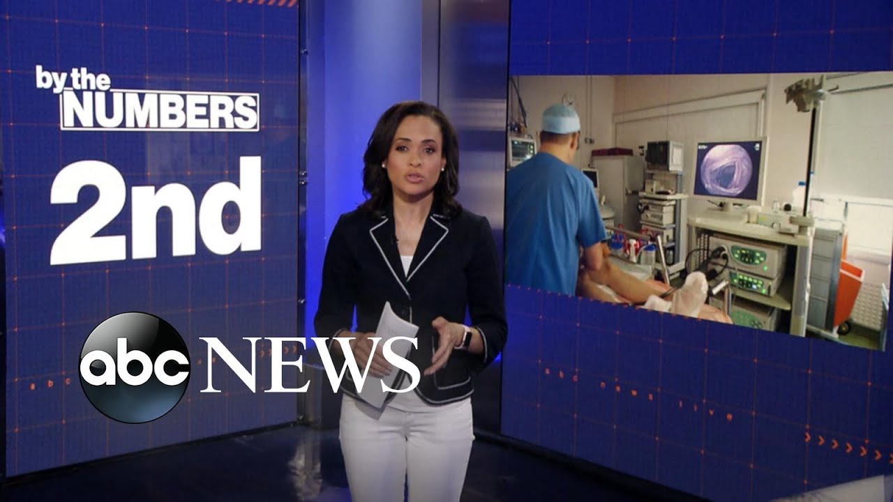 By the Numbers: Colon cancer screenings should begin at age 45