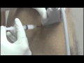 Ultrasound Guided Shoulder Injection