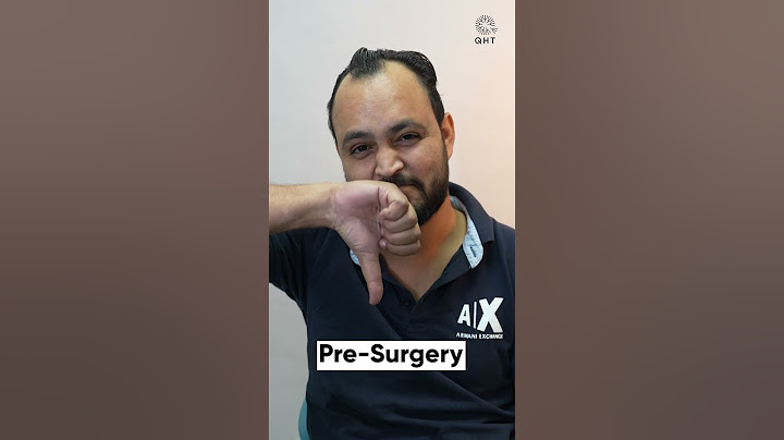 Hair Transplant Surgery Experience | Latest Fue Technique #shorts #viral #hair transplant