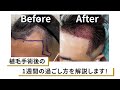 【不安解消】植毛手術後1週間の過ごし方を解説します!