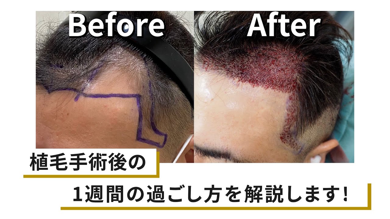 【不安解消】植毛手術後1週間の過ごし方を解説します！