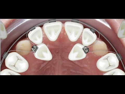 Video: When Teeth Are Out Of Place - Alternative View