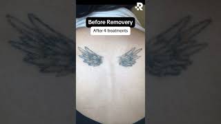 Tattoo Removal Results 😍 #removery Wealth
