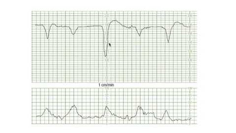 Decelerations Complicated Variables