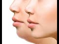 Perfiloplastia facial: ¿Cómo conseguir un rostro más perfilado?