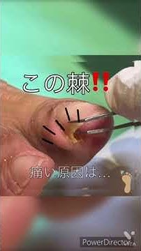 痛い巻き爪の原因は殆ど【これ😭】