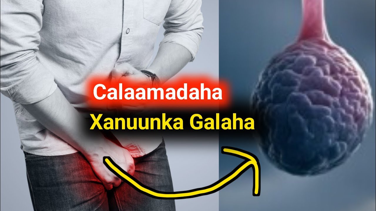 Xanuunka Galaha calaamadihiisa iyo xaniinya xanuunka xiriirka ka dhaxeeyo
