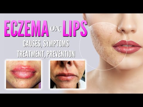 Video: Cheilitis On The Lips - Classification, Treatment