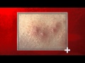 Gambar cover Signs of Bed Bug Bites - Health Checks