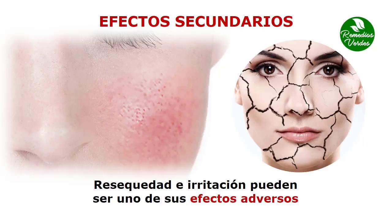 Para Que Sirve El Jabon De Azufre Beneficios Del Jabon De Azufre YouTube Para Que Sirve El Jabon De Azufre Beneficios Del Jabon De Azufre YouTube