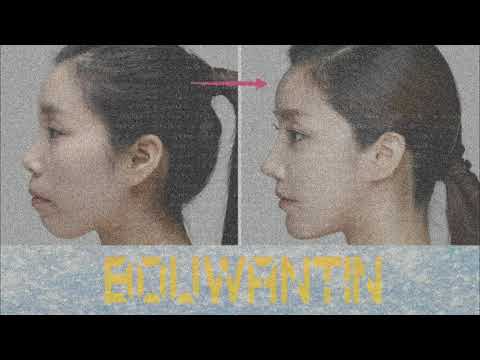 Video Chữa răng hô | treat coral teeth | Subliminal - youtube