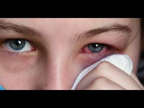 تخلصى من الاحمرار والحكة بالعين بمكونين فقط وصفة مضمونة لتطهير العين