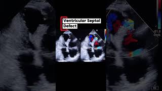 Qp:Qs on Echocardiography