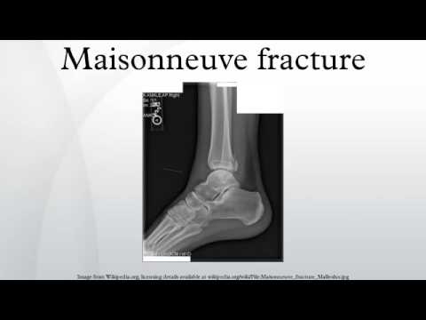 Maisonneuve Fracture Youtube