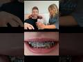 Braces Power Chains Explained