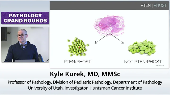 Mosaicism & Masses- PTEN, PROS, & Beyond