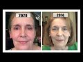 Changes in My Skincare + 6 Years Using Retin A~Comparison Footage