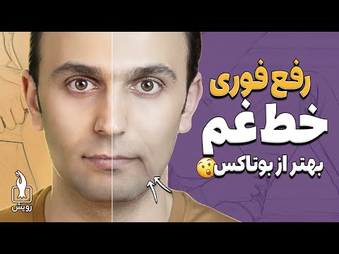 حذف خط غم یا خط اندوه افتادگی گوشه لب ها با ماساژها و حرکات خانگی بسیار موثر و ماندگار