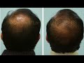 Dallas Hair Transplant Before and After Photos