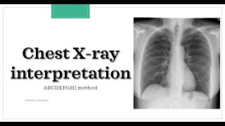 Chest X-ray interpretation (ABCDEFGHI method) screenshot 3