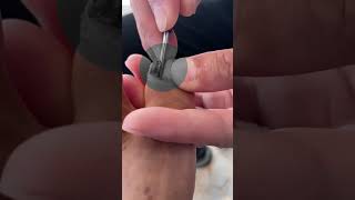 TOE HORROR STORY: THE MOST INTENSE INGROWN TOENAIL REMOVAL EVER FILMED! | INGROWN TOENAIL