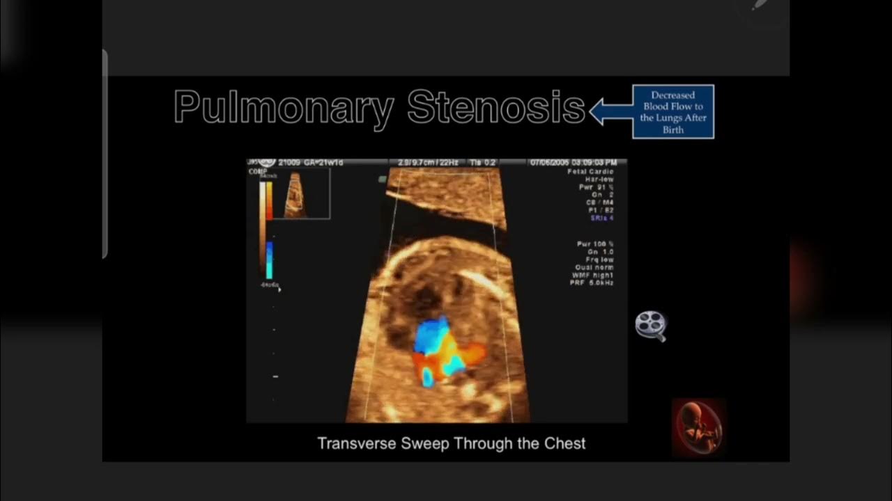 fetal pulmonary stenosis echo شرح صوتي - YouTube