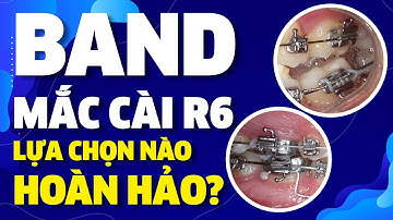 Band Và Mắc Cài Răng 6 | Ưu Và Nhược Điểm | Nam Bui Vinalign