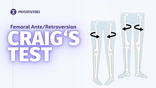 Craig's Test | Femoral Anteversion by Physiotutors 9,225 views 3 months ago 3 minutes, 12 seconds