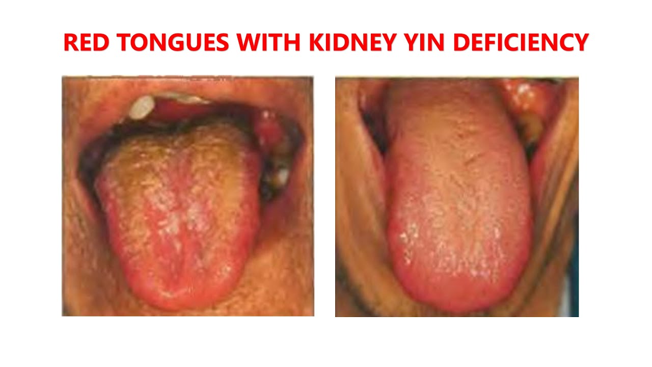 RED TONGUES WITH KIDNEY YIN DEFICIENCY - YouTube