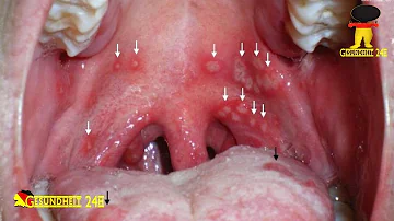 Wie steckt man sich mit Herpangina an?