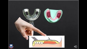 IMPRESSION TECHNIQUES & JAW RELATIONS IN REMOVABLE PARTIAL DENTURES