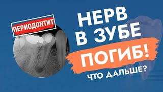 Нерв в зубе погиб. Что дальше?