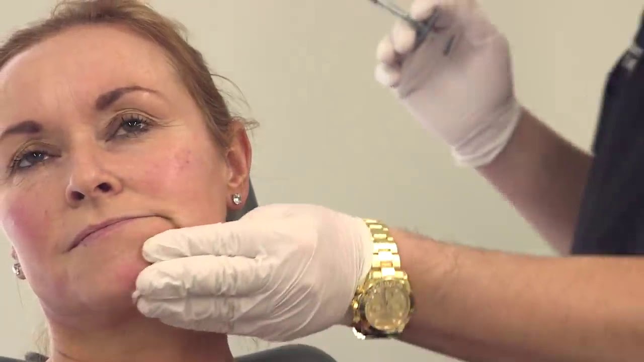 Full face filler treatment non surgical volumetric facelift 2 YouTube