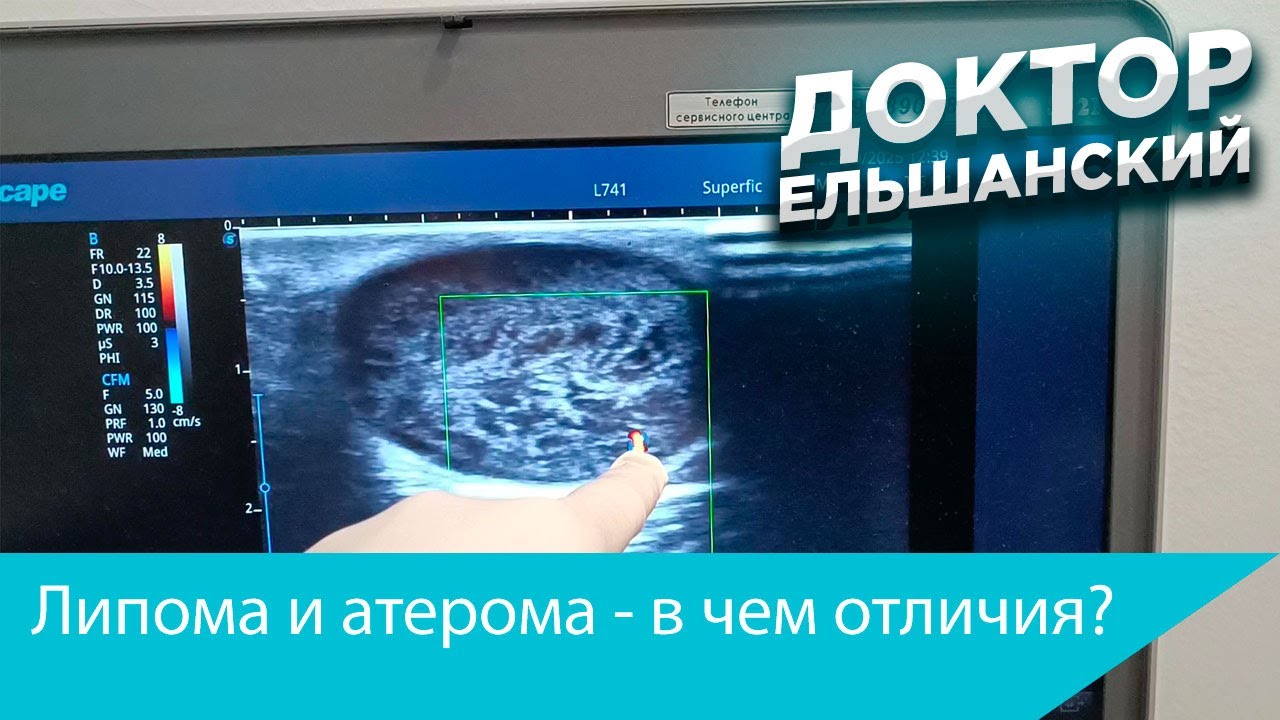 Липомы и атеромы в чем отличия