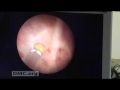 Kidney Stone Removal - a new approach at Detroit Medical Center