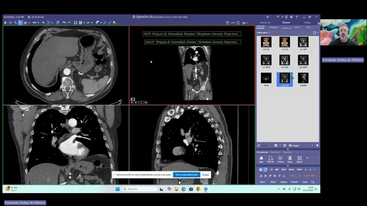 Qual a importância de utilizar o MIP e o MINIP nos exames de tomografia computadorizada.