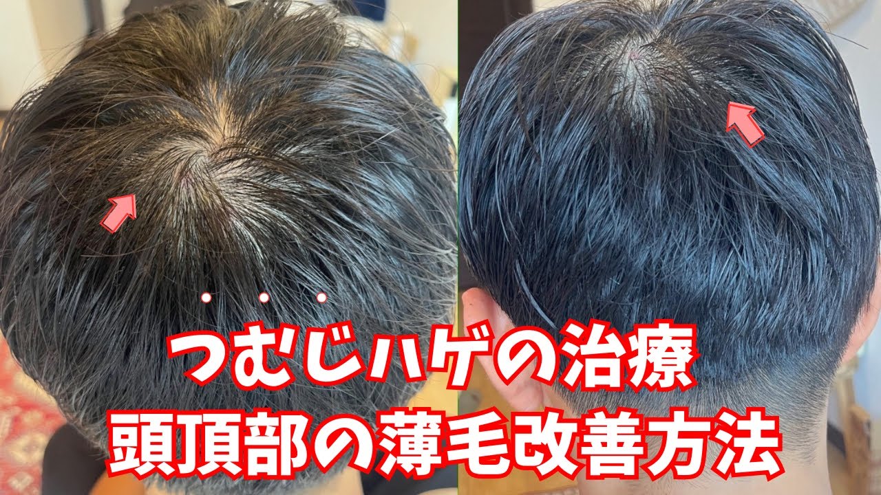 頭頂部の薄毛を本気で改善させる方法とは?【つむじハゲ・てっぺんハゲ】 - YouTube