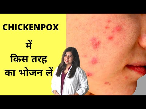 Best Foods For Chickenpox, चिकन पॉक्स में किस तरह का खाना खाएं