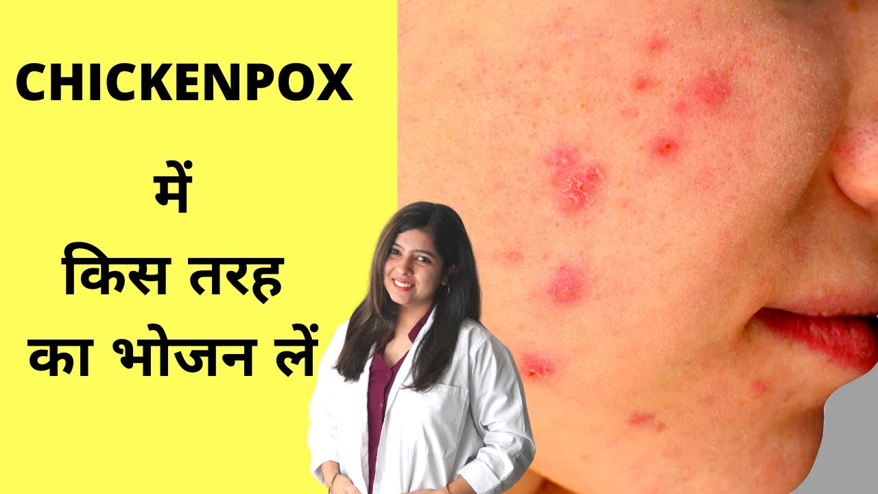 Best Foods For Chickenpox, चिकन पॉक्स में किस तरह का खाना खाएं YouTube