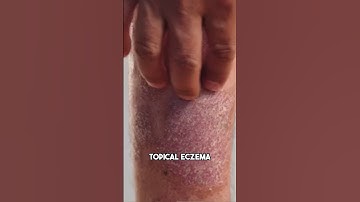 How to cure eczema #eczema #skinhealth #skincare #health