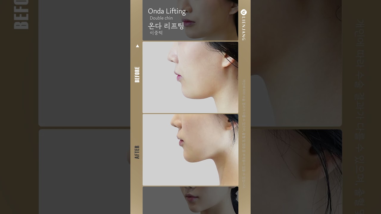 [Риенжанг гоо сайхны мэс заслын эмнэлэг] Онда лифтинг давхар эрүү