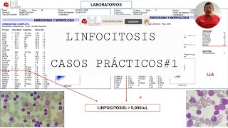 Linfocitosis. Caso Clínico De Llc Vs Lla.
