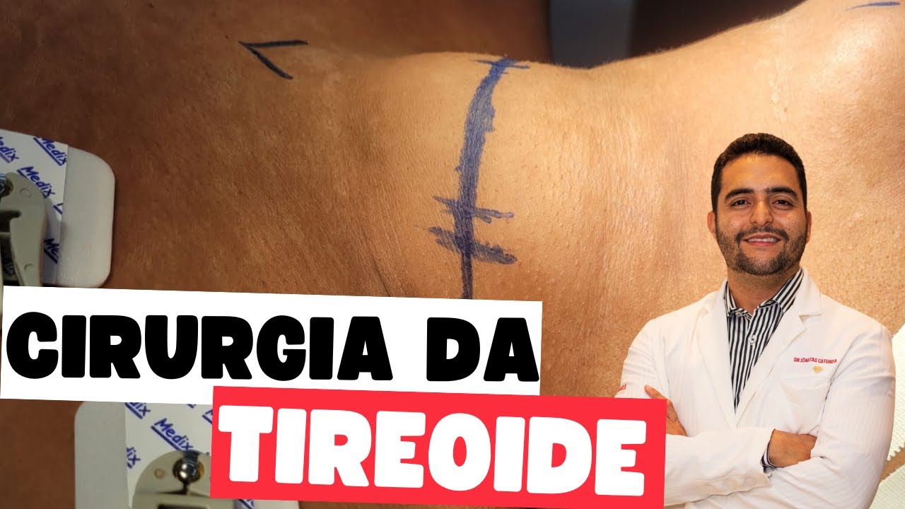 Tireoidectomia total - Riscos, complicações / Hiperparatireoidismo secundário