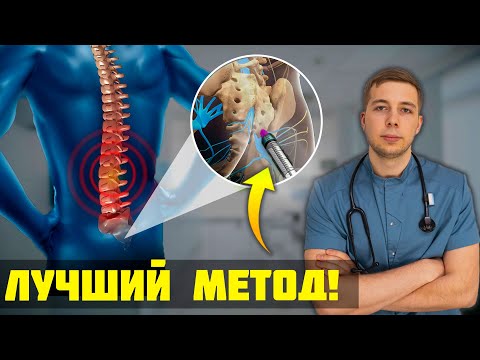 Самый ЭФФЕКТИВНЫЙ метод лечения боли в спине и ишиасе - Эпидуральная блокада!